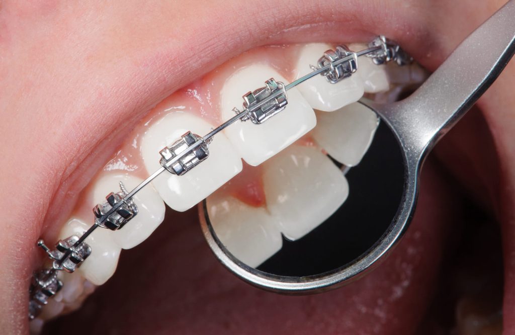 Ortodonzia-Tradizionale